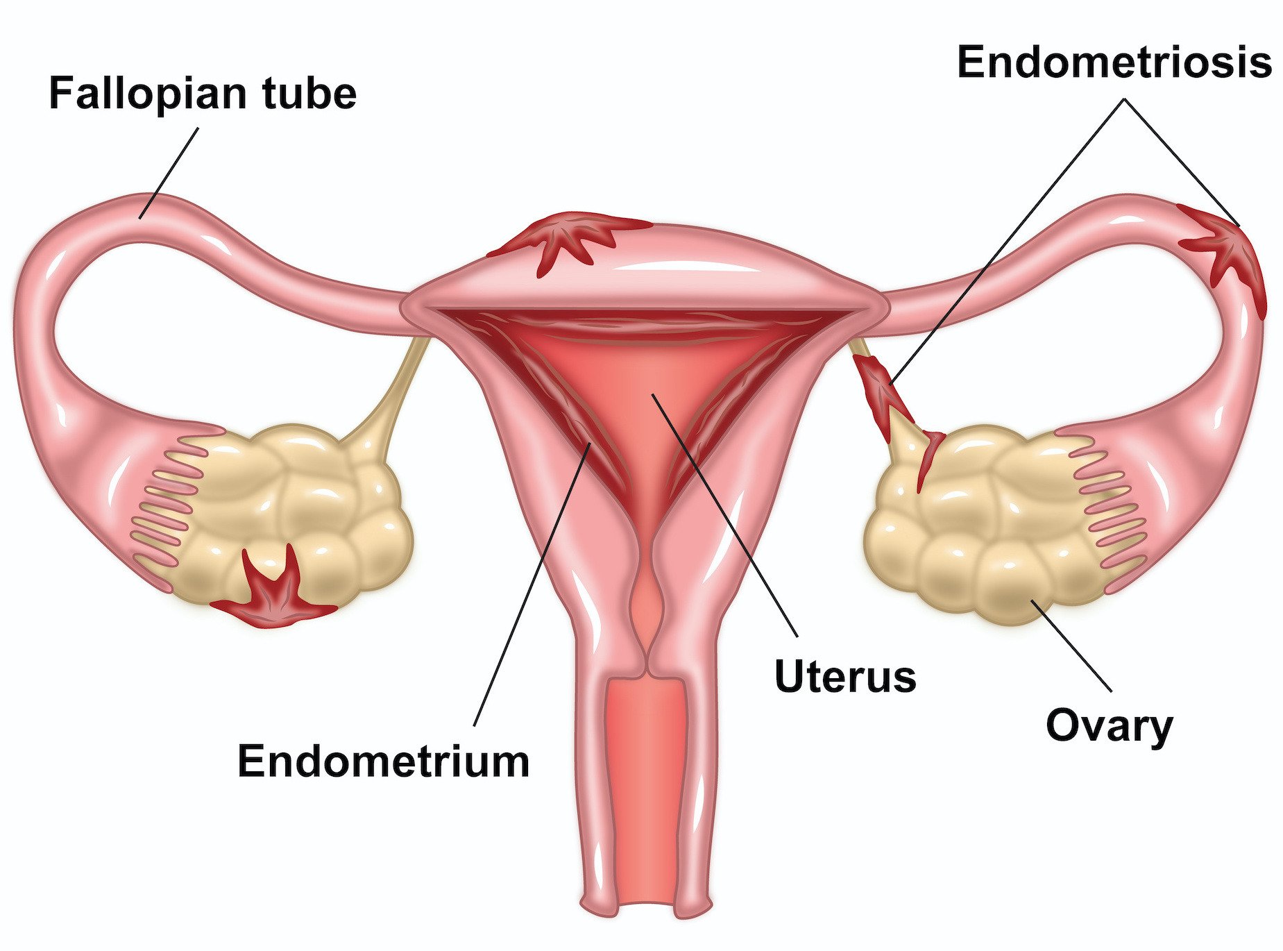 Endometriosis is a chronic condition where tissue similar to the lining inside the uterus grows outside of it, causing pain, inflammation, and sometimes infertility. While some women may experience symptoms like painful periods, fatigue, and intense pelvic pain, others may be asymptomatic (known as “silent endometriosis”), discovered only when facing infertility issues. 